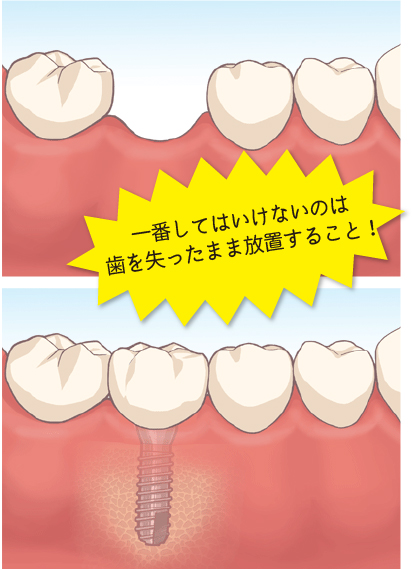 一番してはいけないのは歯を失ったまま放置すること!