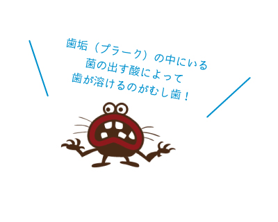 歯垢(プラーク)の中にいる菌が出す酸が歯を溶かすのが原因!
